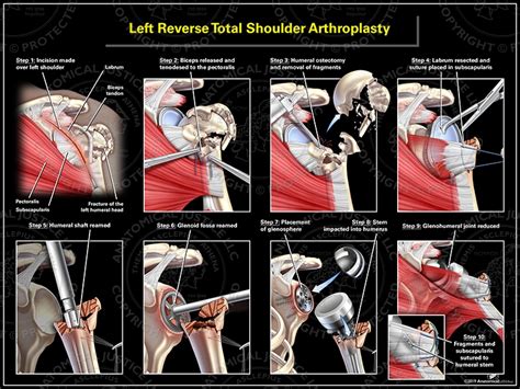 left reverse total shoulder arthroplasty icd 10